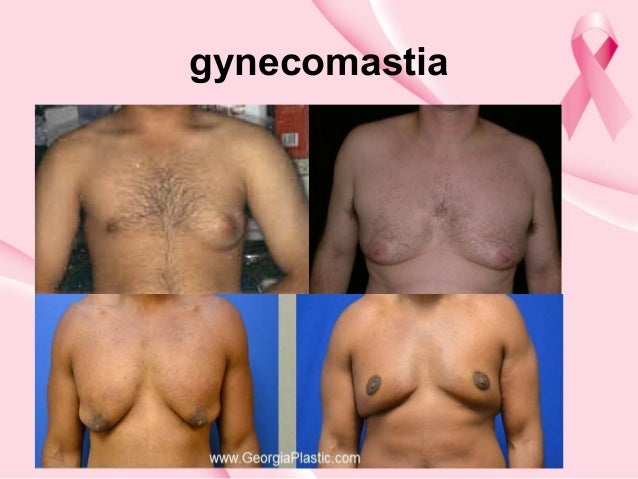 man breast disease Cuckold orgasm tube